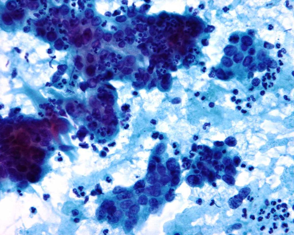 Endocervical adenocarcinoma Different histologic types cytology?