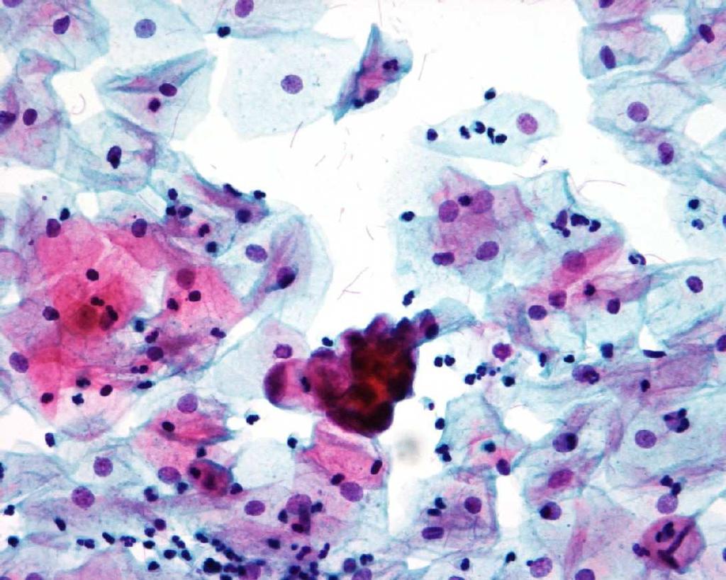 Other glandular cells - mlg Extrauterine adenocarcinoma Ovary Fallopian tube