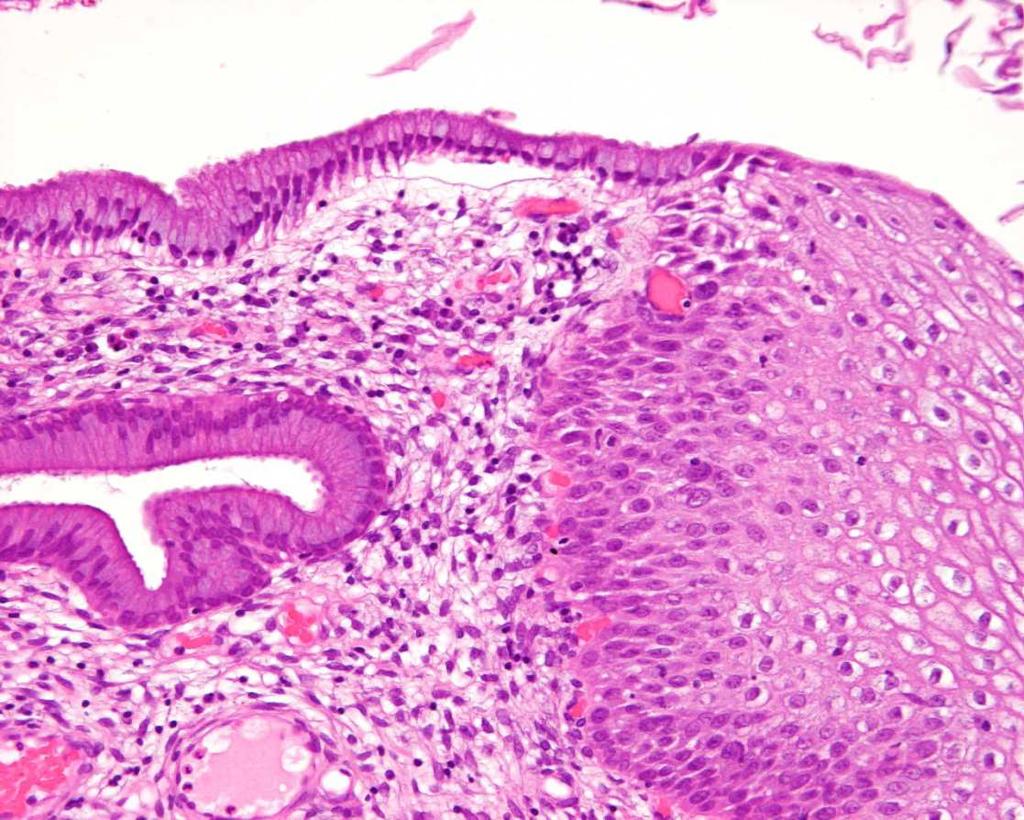 Glandular cells in cervical smears Transfomation cone junction cone Endocervical cells key component of Pap test No sq metaplastic/ endocervical