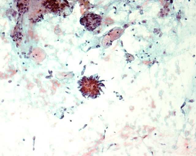 CERVICAL CANCER AUDIT Underdiagnosed cases: representative highly atypical glandular cells found on the review but