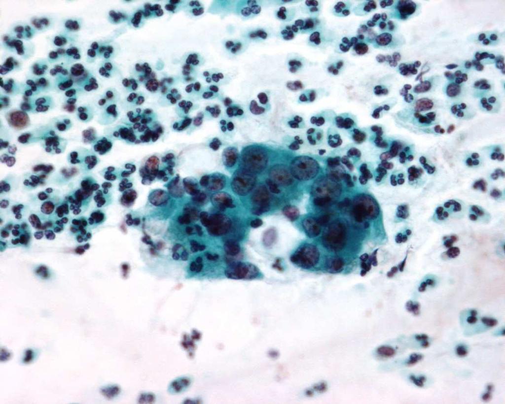 Reactive endocervical cells Common Hormonal influences Inflammation Polyps DD: neoplastic