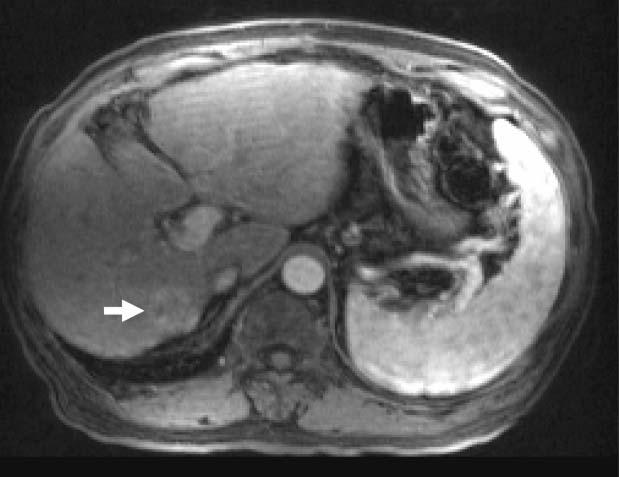 Percutaneous RFA of colorectal liver metastases 155 1a Figure 1. A 51-year-old man with biopsy-proven liver metastasis from colon cancer. a.