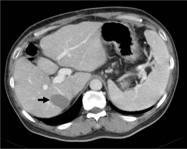 Contrast enhanced CT scan 1 month after RFA shows total necrosis (arrow) of the tumor, which had been treated with percutaneous ultrasound-guided RFA. 1b Table 1.
