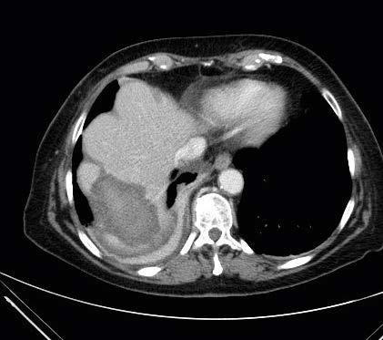 metastases can be coagulated. In the present ent case an intratumoral placement of applicators was chosen.
