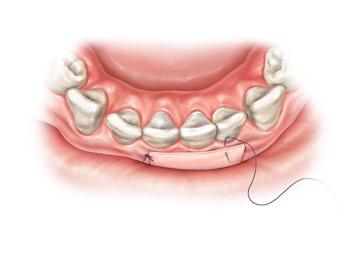 Subepithelial Connective Tissue Graft (CTG) This procedure combines the most positive features of the free gingival graft and the pedical graft, namely good tissue keratinization and additional blood