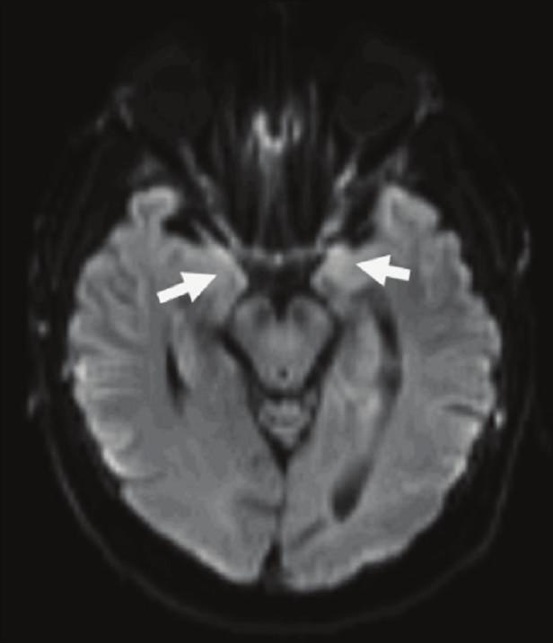 shows brain MRI (from left to