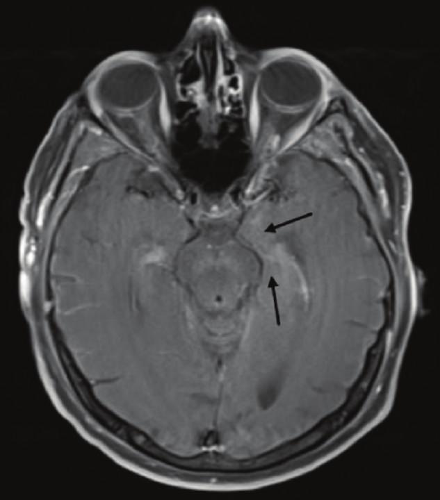 brain MRI after treatment shows