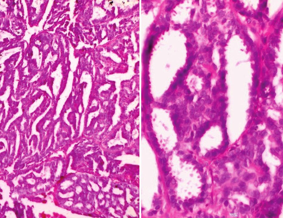 The tumor is composed of Figure 2: Photomicrogrph of hidrdenom ppilliferum showing () tumor composed of tuulr nd cystic structures with ppillry folds projecting into cystic spces (H nd E, 100) ()