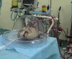 Resuscitating Donor Lungs: Ex