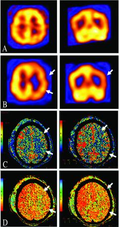 Single-photon emission CT images (B) showing moderately decreased perfusion in the left posterior frontal and parietal regions (white arrows), indicating a left MCA vasospasm.