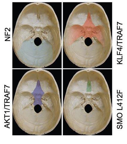 Molecular Genetics of Anterior Skull Base Meningiomas SMO and AKT1 mutations occur in some skull base meningiomas Targeted sequencing of SMO and AKT1 performed in 62 patients with anterior skull base