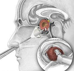 Surgical Approaches to Compressive Lesions Involving the Anterior Visual Pathway The optimum approach to pituitary adenomas and other lesions that compress the optic nerves and/or chiasm continues to