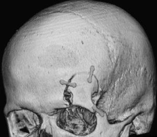 discuss the pros and cons of the transciliary keyhole approach compared with open craniotomy Most favor the keyhole approach because of