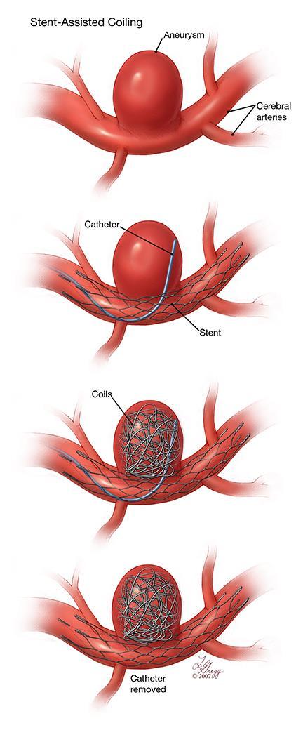 Visual Effects of OSA Treatment Two-center retrospective cohort comparison of stentassisted coiling vs Pipeline (flow diversion) device 172 patients 62 treated with stent-assisted coiling 106 treated