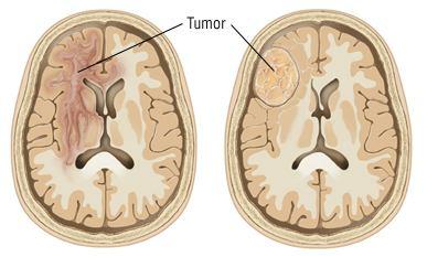 Automatic Detection of Brain Tumor Using K- Means Clustering Nitesh Kumar Singh 1, Geeta Singh 2 1, 2 Department of Biomedical Engineering, DCRUST, Murthal, Haryana Abstract: Brain tumor is an