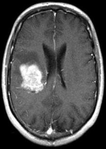 MRI of Abnormal Brain Tumor detected Tumor detected 11.2069 The results of the K-means clustering technique using the original filtered image are shown below in Fig. 5: a b c d e f g h Fig.