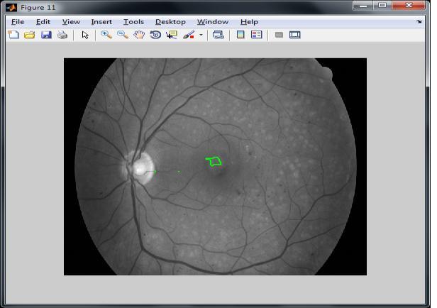 Combining Algorithm For Automatic Detection of Diabetic Retinopathy 8.1. DR grading In DR grading, measure the performance of proposed system.