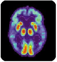 AD and the Brain The Changing Brain in Alzheimer s Disease