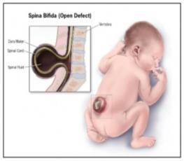 SPINA BIFIDA: THEN AND NOW 1991 Australia incidence 1:800 live births (Spina Bifida Association of New South Wales, 1991) Poor maternal nutrition thought to contribute to incidence Common to have