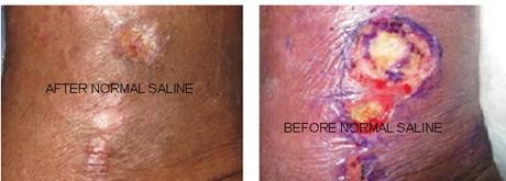 Daily treating the wound with normal saline religiously for more than 10 days allows skin integrity to remain intact.