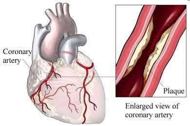 CORONARY ARTERY RESPIRATORY ASSESSMENT (CRA) Coronary artery disease (CAD) occurs when the blood vessels that transport blood to the heart are narrowed and hardened due to plaque buildup