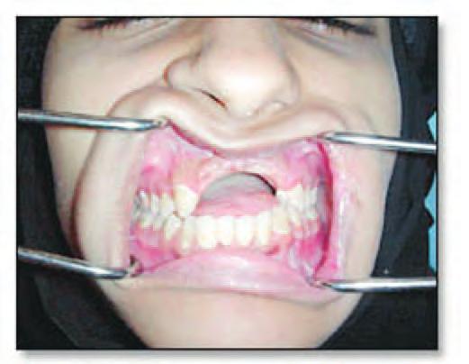 deficiency of the anterior region of maxilla was represented by bone loss in anterior-posterior dimension, which significantly compromised the smile line.