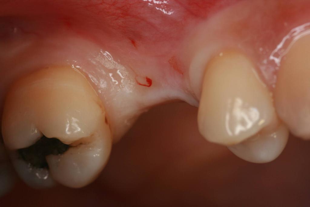 Clin Oral Implants Res 1997;8:39-47. 16. Scipioni A, Bruschi GB, Calesini G, Bruschi E, De Martino C.