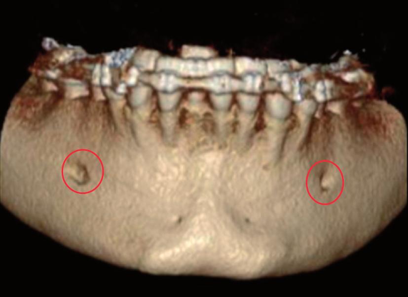 Seoun J.D.M., Surmenin J., Dirt S. Accelerted orthodontic tretments with Piezocision 313 2. Piezocizion: minimlly invsive technique of lveolr corticotomy 2.1. Initil periodontl exmintion nd mngement Figure 2 3D Imging (Cone em computed tomogrphy) for surgicl plnning.
