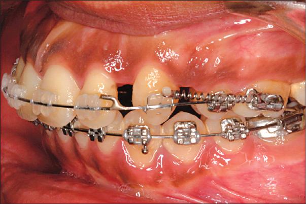fcing the socket of the extrcted tooth