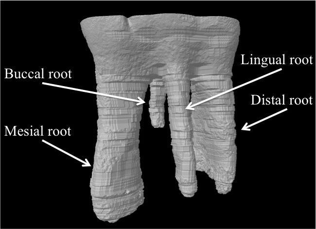 Figure 5: Four roots of M1 The mesial, distal, buccal, and