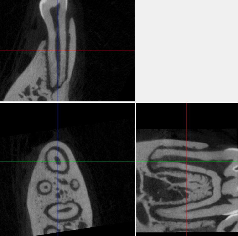 38 Figure 9: Mandible positioning at M1 A sagittal slice through M1 exposed a level furcation roof (right). A frontal slice through the mesial root showed that the root was aligned vertically (top).