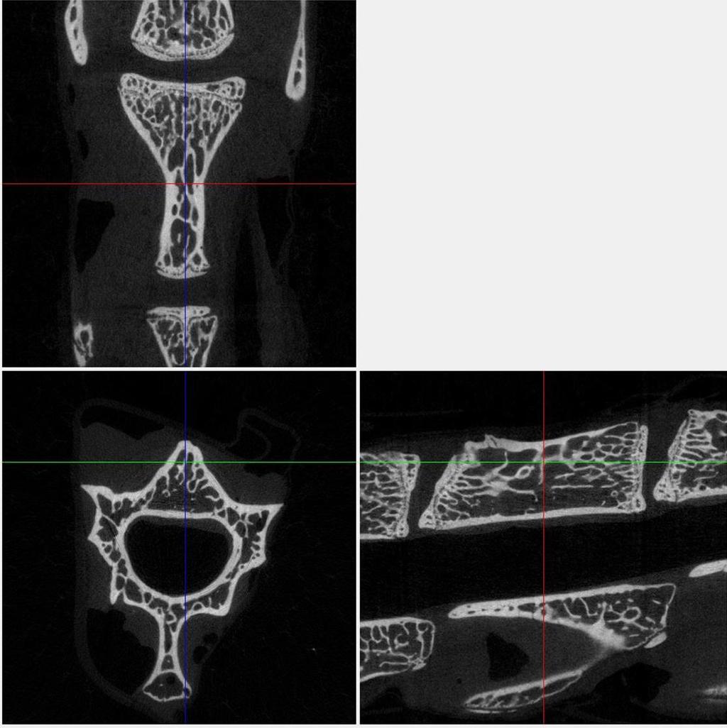 43 Figure 14: Lumbar vertebrae positioning A sagittal slice exposed a vertebral body that is aligned horizontally with a superior vertebral growth plate that is aligned vertically (right).