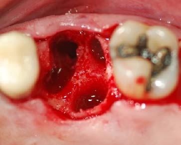 that is designed to minimize external resorption of the ridge and