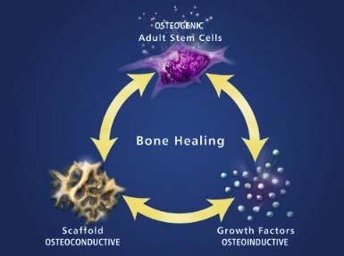 Principles of Guided Bone Regeneration Osteoconduction graft acts a scafffold through which osteoblasts and fibroblasts and blood vessels can grow (FDBA, xenografts, synthetic alloplasts)