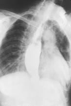 lung disease in SSc