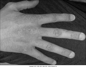 Newer classification Gottrens papules Inclusion body myositis
