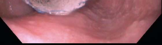 2. Widely patent gastroesophageal junction.
