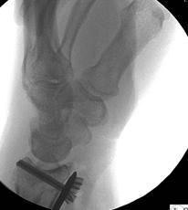 Complications by the Steps of the Procedure Intra operative Plate too distal Flexor tendon