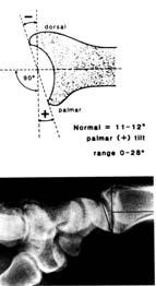 Anatomy: Radiology Palmar Tilt (Sagittal Tilt) 10 degrees (0 28) Unstable Fracture Lafontaine (repeated what