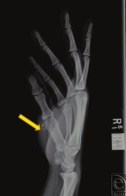 eplasty VOLUME 12 CASE REPORT Figure 1. X-ray. Two 4-mm, radio-opaque masses (arrow) can be visualized alongside the volar and radial aspect of the head of the right first metacarpal bone.