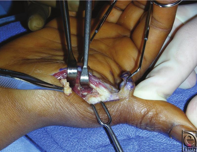 eplasty VOLUME 12 During surgery, access to the masses was achieved by making an L-shaped incision transversely along the digital-palmar crease of the thumb and extending it distally up the radial