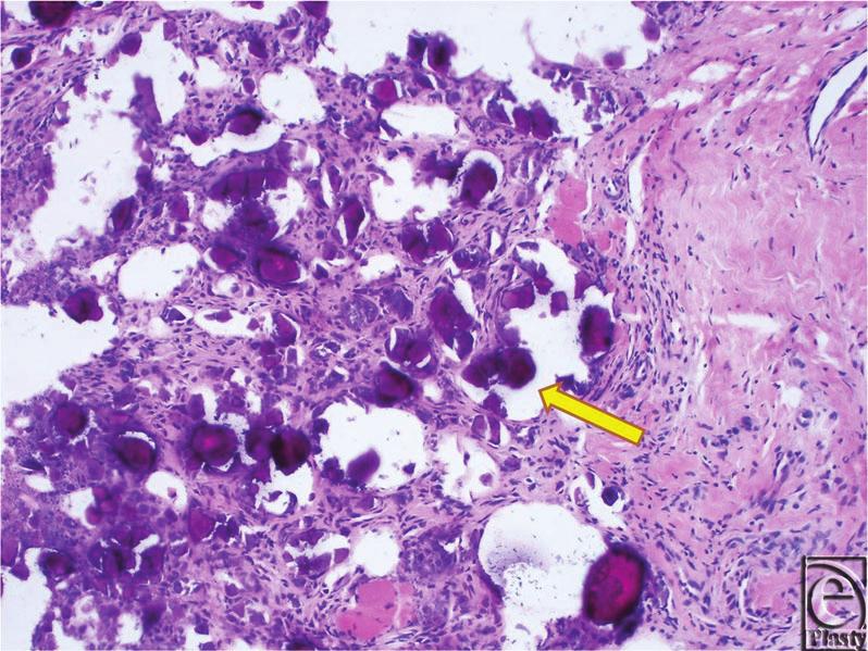 HENRY AND TEVEN Figure 4. H& E staining of excised masses. The purple granules (arrows) were determined to be result of tumoral calcium phosphate deposition disease (calcinosis).
