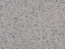 (x 200) histochemical stain of the small bowel tumor was positive for smooth muscle actin but negative for c- kit,