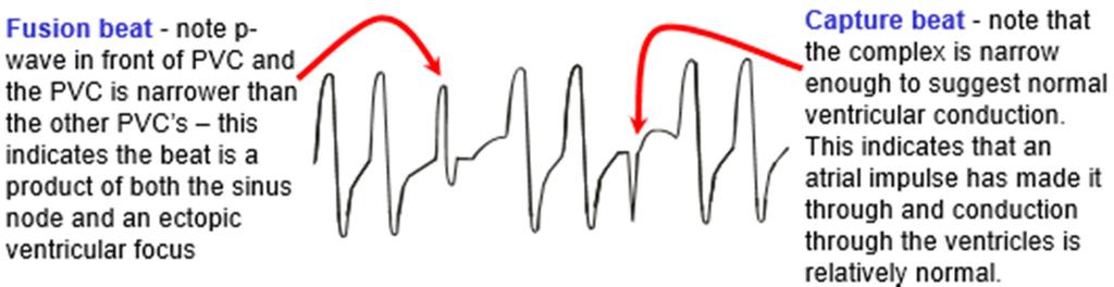 PVC's are Dangerous When: They are frequent (> 30% of complexes) or are increasing in frequency The come close to or on top of a preceding T-wave (R on T) Three or more PVC's in a row (run of V-tach)