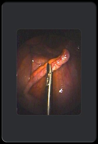 Appendicitis Appendicitis, inflammation of the appendix, is the most common surgical disease. It results from the obstruction of the opening to the appendix by a mass, stricture or infection.
