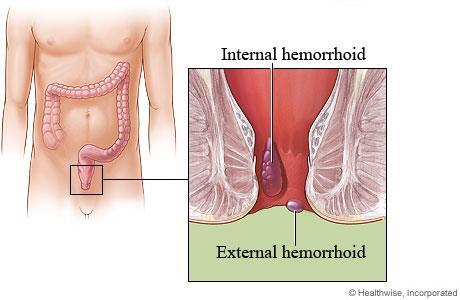 Hemorrhoids Enlarged veins in the lining of the anal canal Common problem, can be painful, but usually not serious Too much pressure on the veins in the pelvic and rectal area