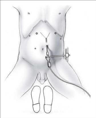 Minimally Invasive Esophagectomy UCSF Experience - Oct. 2007 and Feb.
