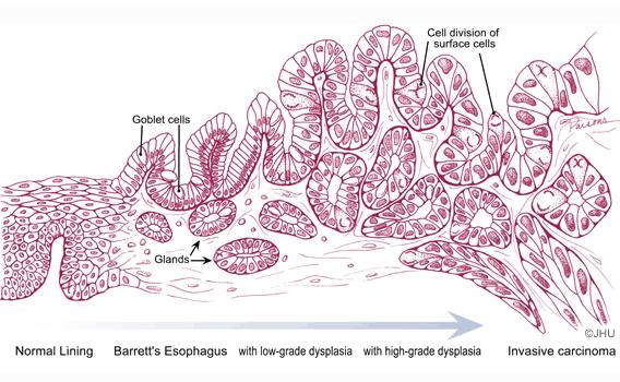 Metaplasia-Dysplasia Progression to Cancer Clinical Grading Dysplasia in Barrett's Esophagus Histologic Intestinal metaplasia Molecular markers