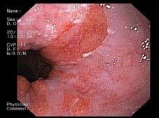 Gut (1998) 43:16 Comparison of Screening Costs Columnar Lined Esophagus Screening Colon Cancer Breast Cancer Heart Transplant Cervical Ca Screening Barrett s q5y at 0.