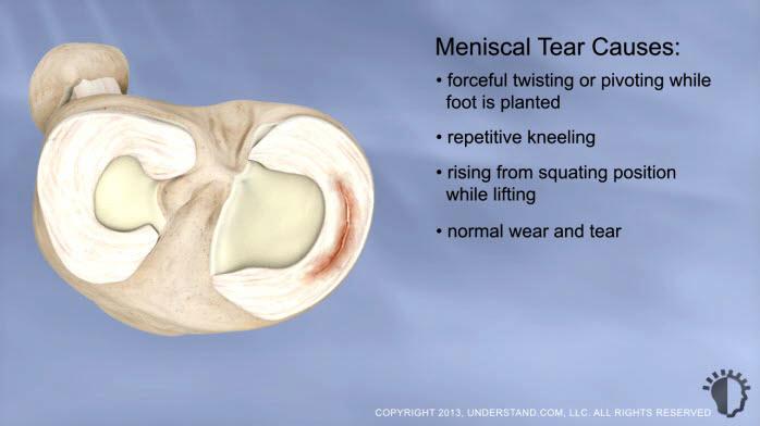 Introduction The two crescent-shaped menisci in each knee absorb shock, disperse weight, and reduce friction when the knee moves.